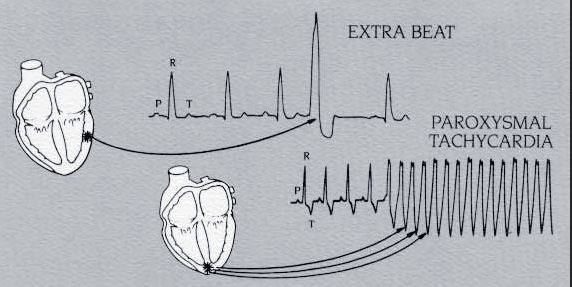 ECG_abnormal